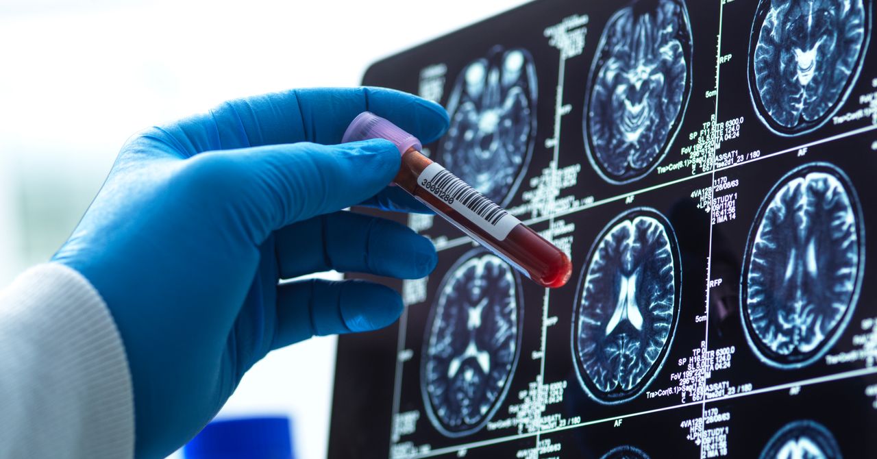 Os exames de sangue para Alzheimer estão aqui
